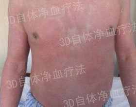 成都银康银屑病医院 牛皮癣疾病的症状有哪些