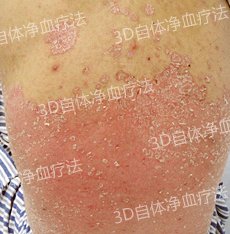 成都银康银屑病医院 牛皮癣疾病怎么治疗好