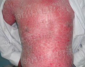 成都银康银屑病医院 牛皮癣治疗方法有哪些