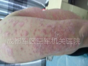 成都银康银屑病医院 夏季诊断牛皮癣方法都有哪些